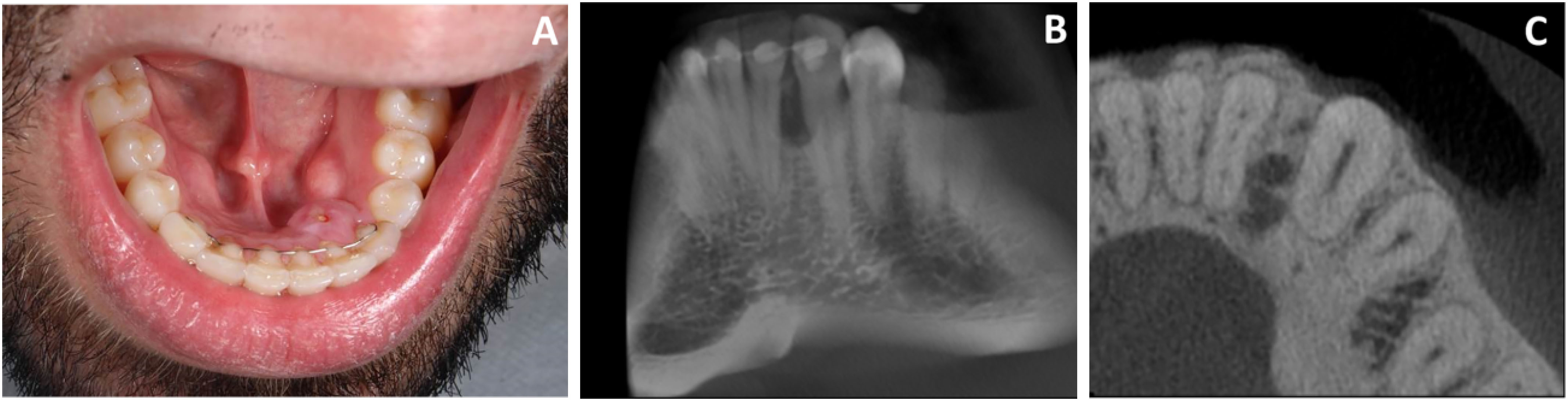 Calcifying Epithelial Odontogenic Tumor