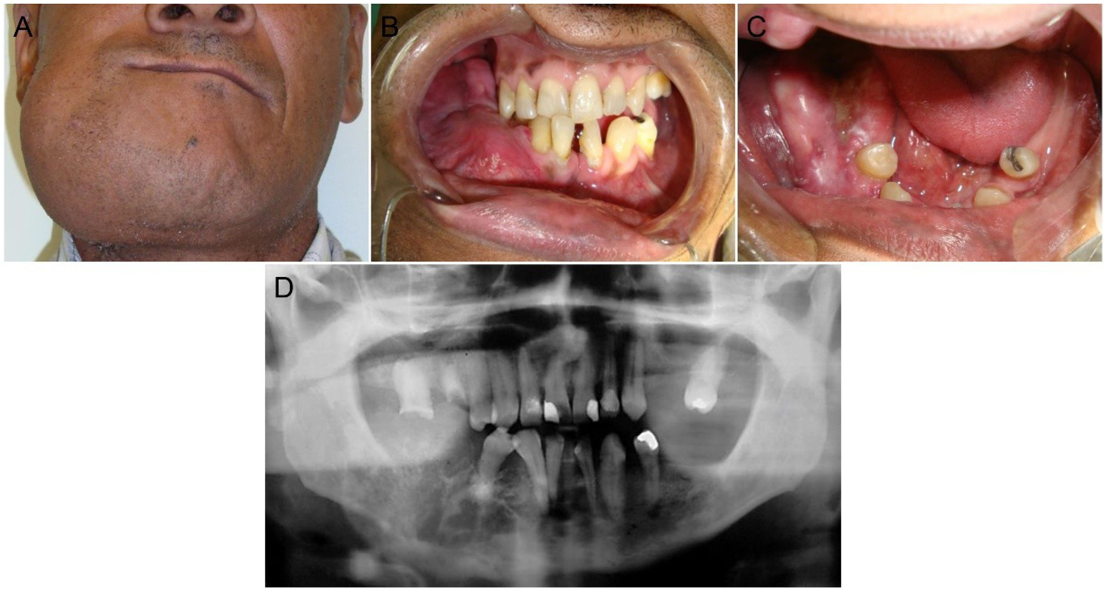 Calcifying Epithelial Odontogenic Tumor Radiographic Features