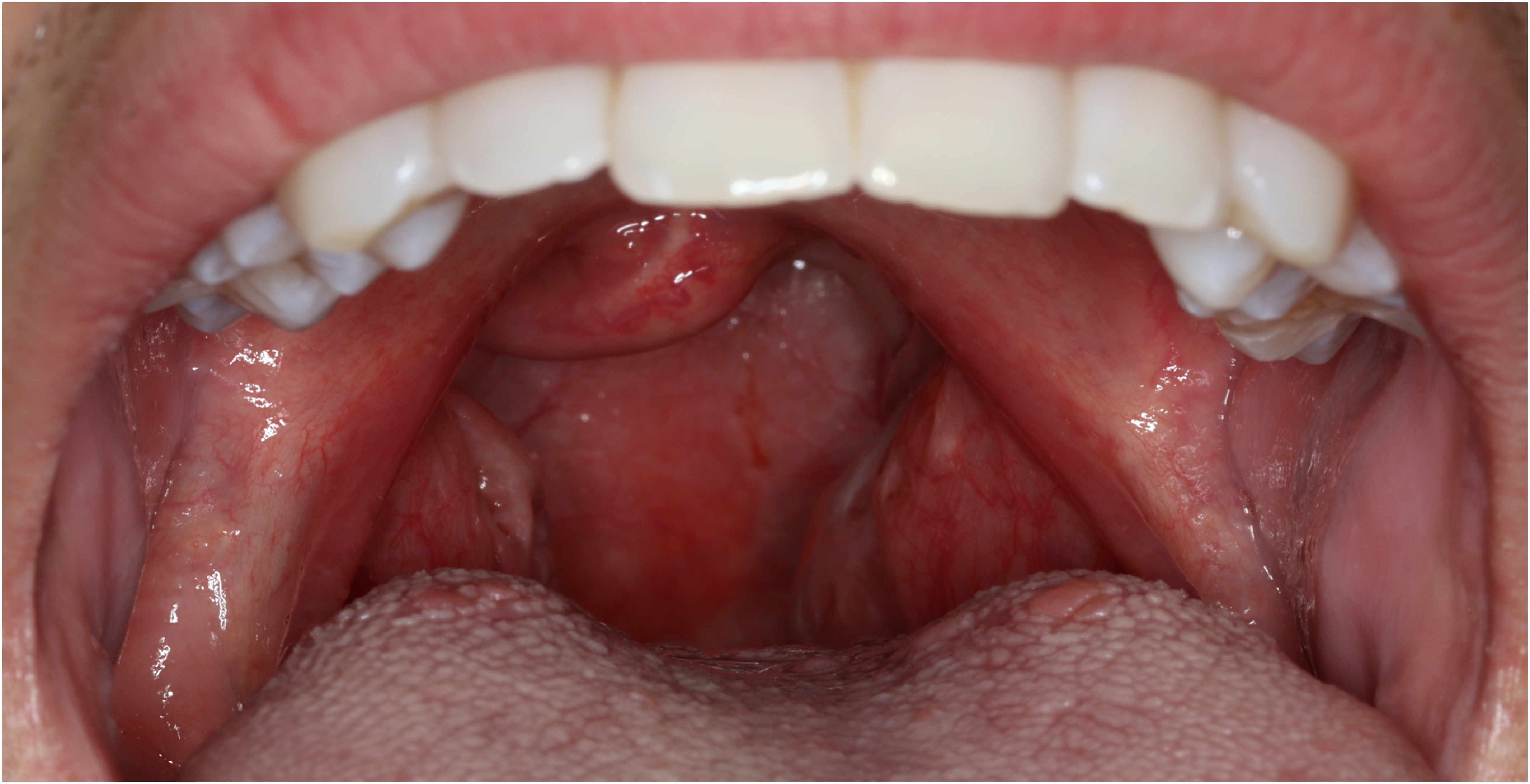 elfbar elfa master akku Throat irritation associated with e-cigarette use: a case report